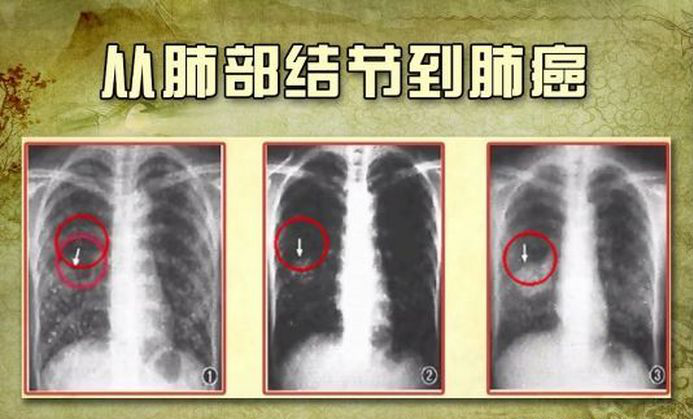 從肺部結節到肺癌.png
